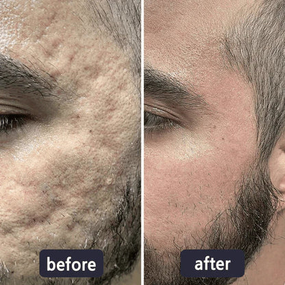 🔥Limited-time 60% sale--LUMIVO Scar Repair Cream — Smooth, Clear, Confident Skin